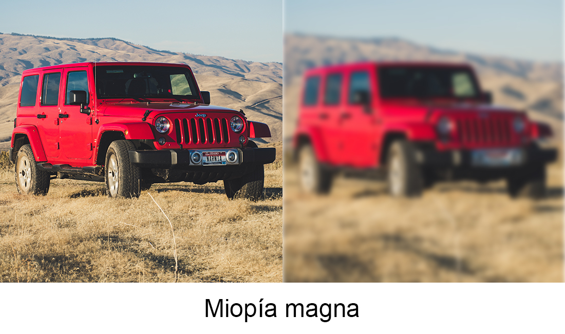 Miopía magna_bv