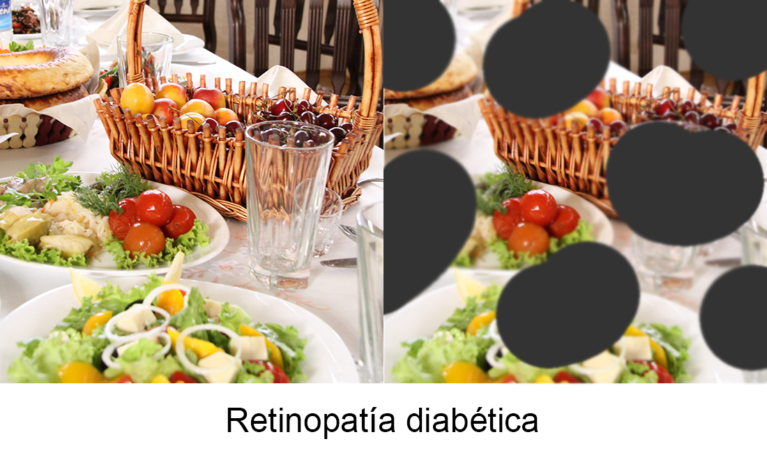 Retinopatía diabética_bv